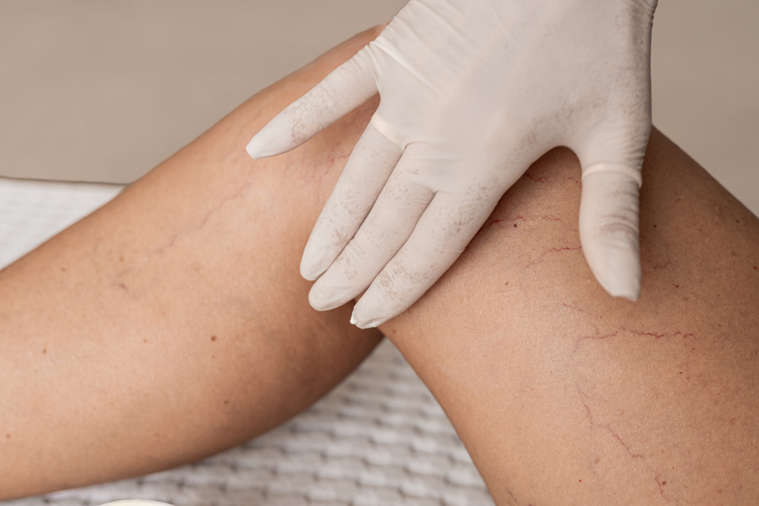 טיפול בנימים